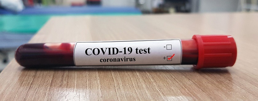 डडेल्धुरा परीक्षणमा थप २० जनामा कोरोना पुष्टि