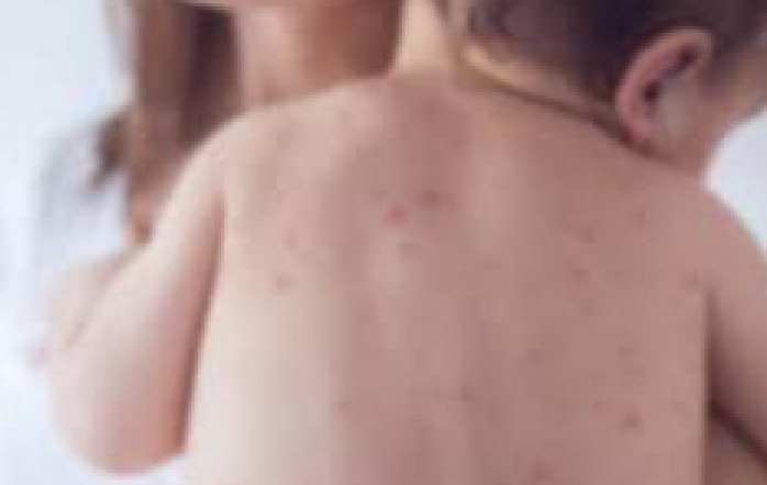 दादुरा रुबेलाका बिरामी भेटिए