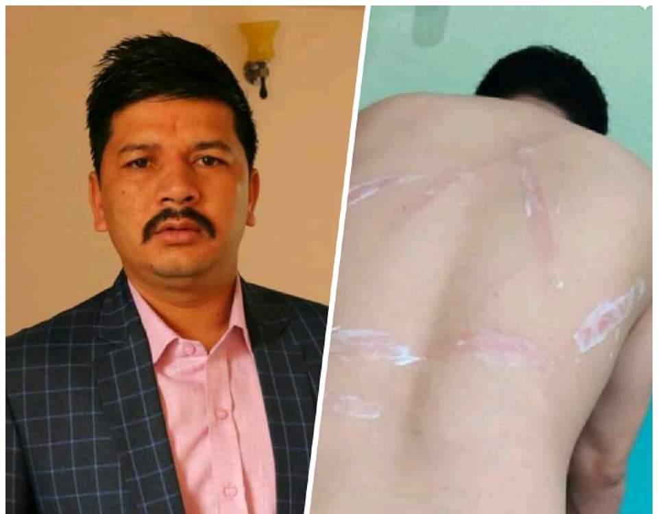 अध्यादेशविरुद्धको प्रर्दशनमा विद्यार्थी नेता राेकाया घाइते