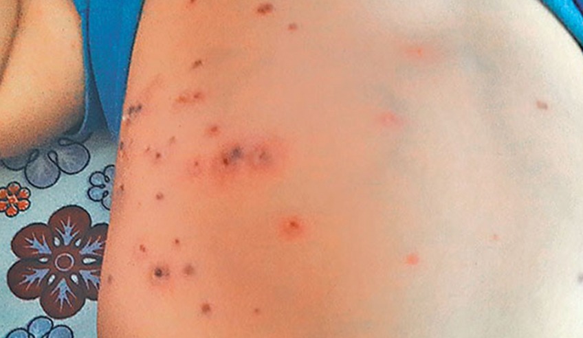 बैतडीमा स्क्रब टाइफसका बिरामी बढ्दै