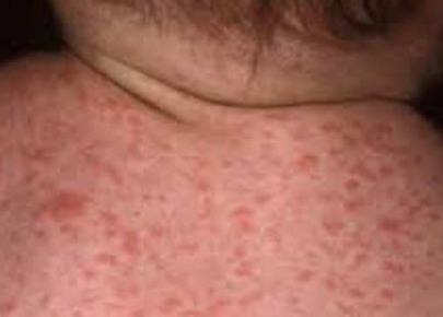 जाजरकोटमा देखिए दादुराका बिरामी