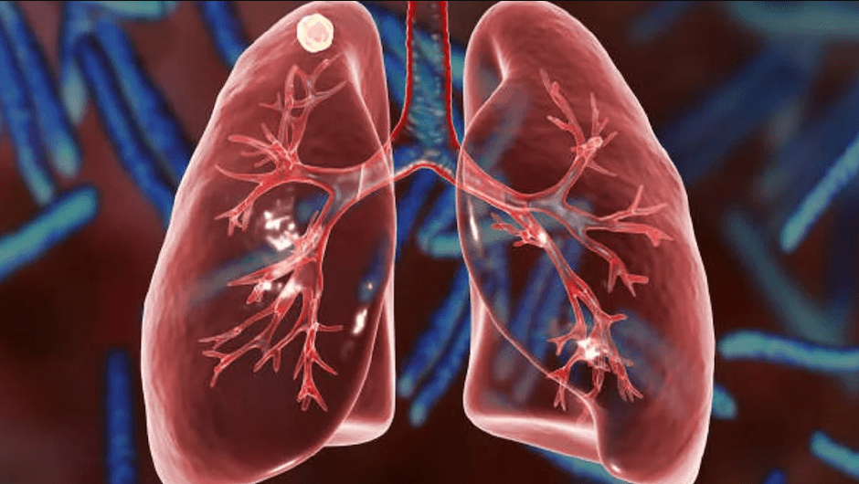 प्रदूषणले फोक्सो बिगारिदिन्छ, यी खानेकुरा खाएर जोगाउनुहोस्