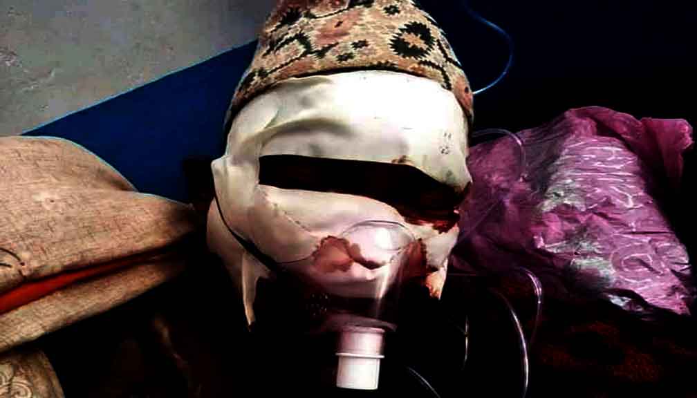 लडेर घाईते भएका दमाईकाे उपचारमा समस्या