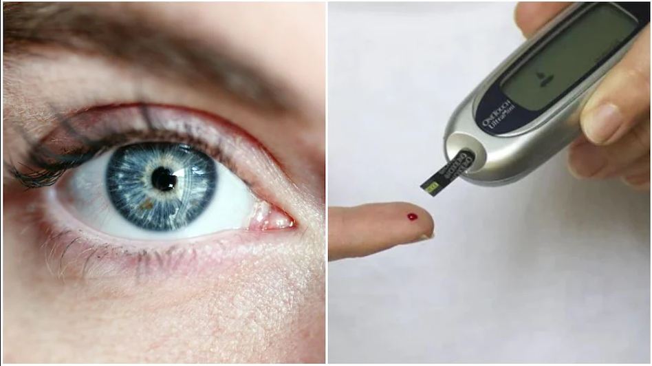 आँखामा देखिने मधुमेहका लक्षणहरु