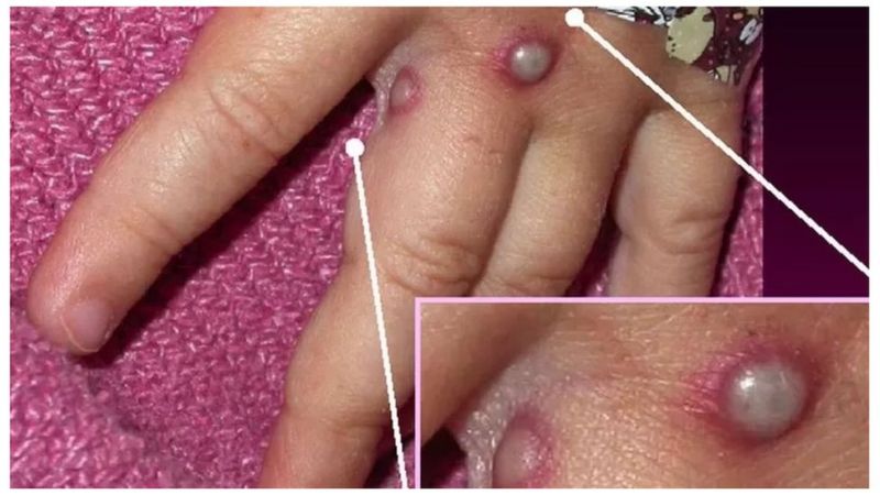 १५ देशमा फैलियो मंकीपक्स संक्रमण