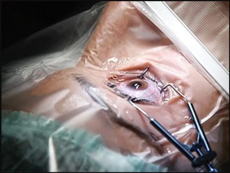 सुदूरपश्चिममा आँखा पाक्ने रोगको प्रकोप फैलियोे, यस्ता छन् सावधानीका उपाय