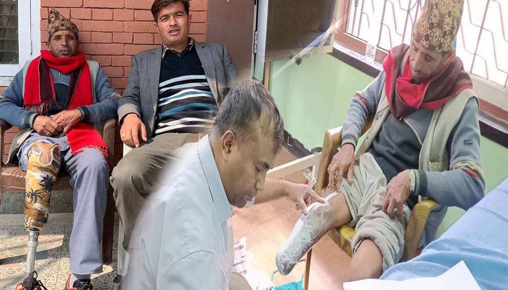 बडीमालिकाका लालमनीको कृतिम खुट्टा फेरियो